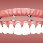 Ką reikia žinoti prieš implantuojantis dantis